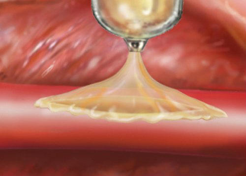 Новий медичний суперклей дозволяє "залатати" тріщини в серці і кровоносних судинах