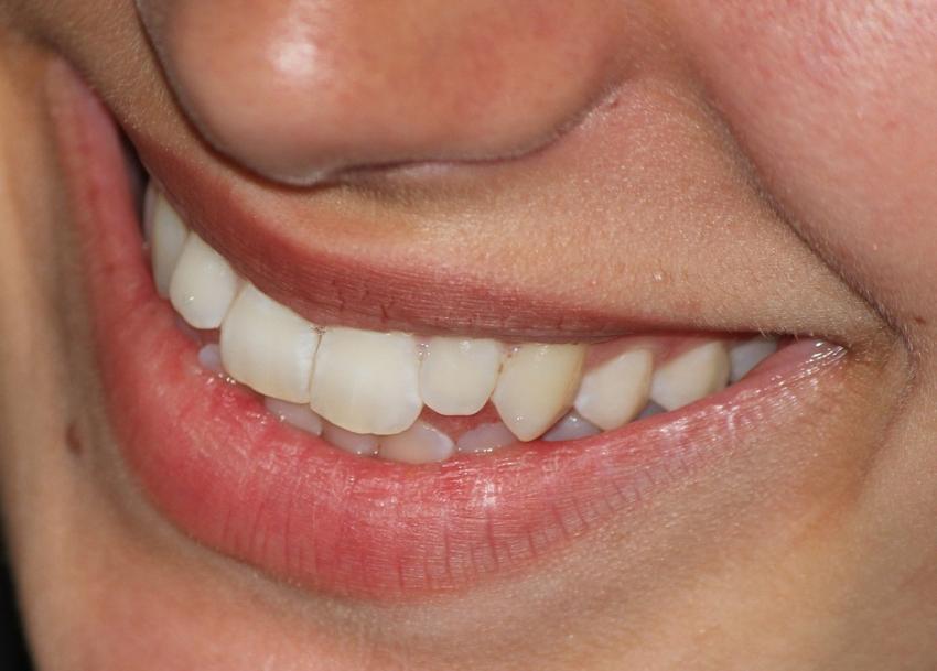 Ученые: Наночастицы диоксида титана отбелят зубы без повреждения эмали