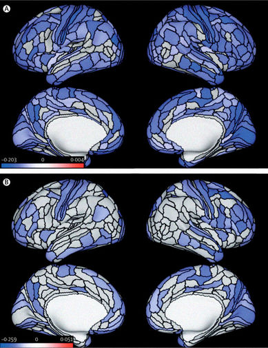 Ученые выяснили особенности строения мозга преступников