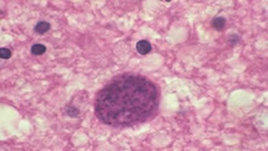 Кіста Toxoplasma gondii в тканині головного мозку. (Репрезентативне зображення)